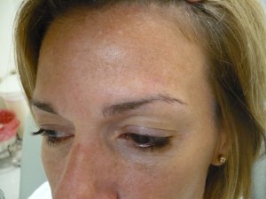 before-after-skin-cancer-pictures before-after-skin-cancer-pictures