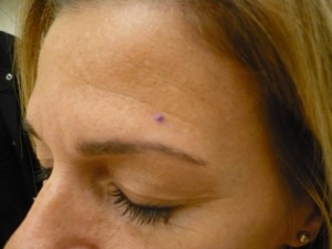 skin-cancer-pictures skin-cancer-pictures
