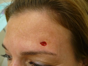 skin-cancer-pictures-after-removal skin-cancer-pictures-after-removal