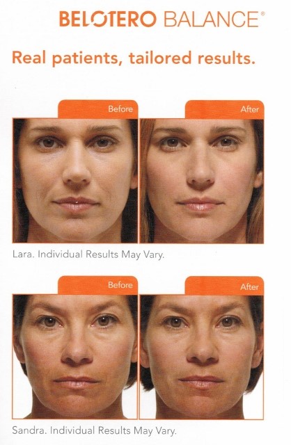 belotero-before-and-after-pictures
