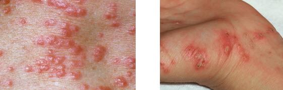 scabies-treatment-jupiter