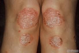psoriasis knees