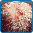 psoriasis-locations-scalp