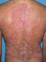 psoriasis trunk