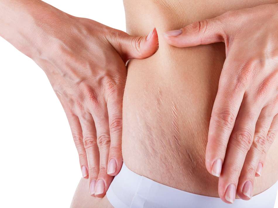 Laser-Stretch-Mark-Removal