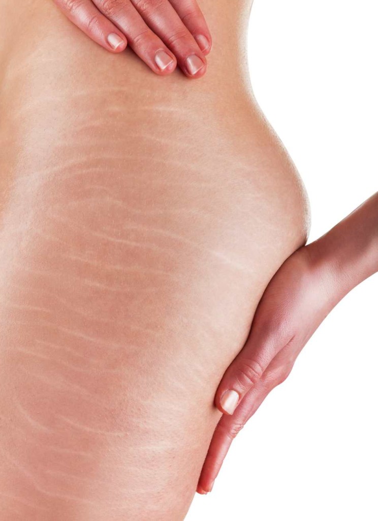Laser-Stretch-mark-Removal (2)