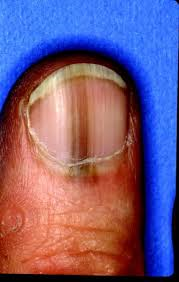 Melanoma Nail Bed melanoma-nail