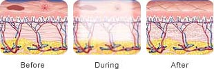 IPl-laser-brown-spots