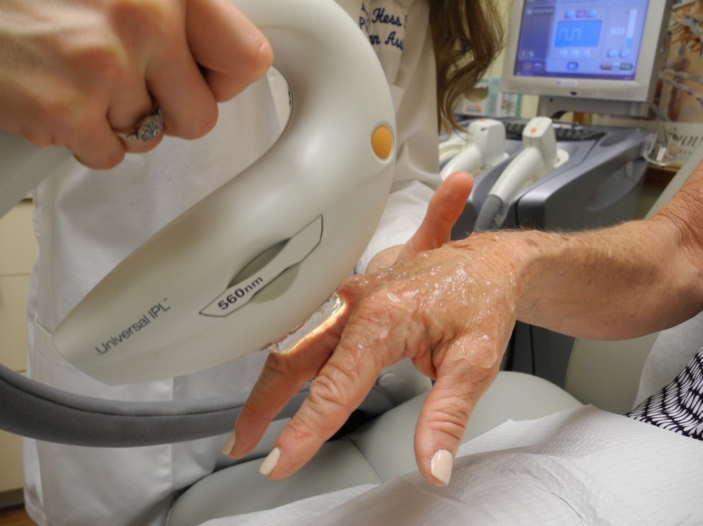 Ipl-treatment