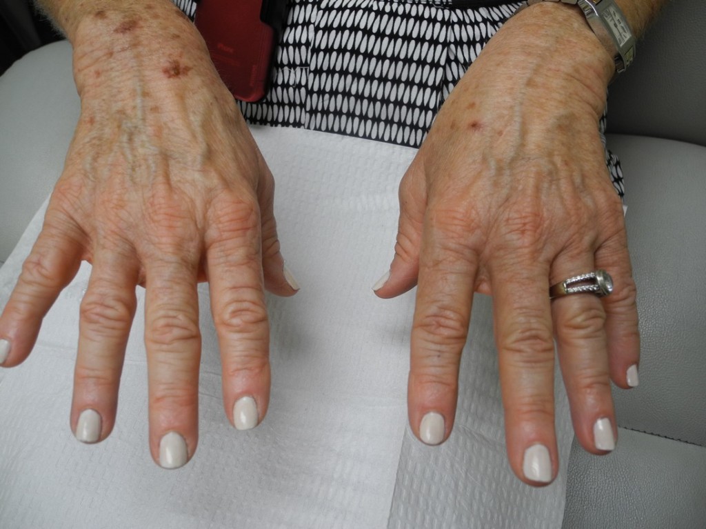 anti-aging-laser