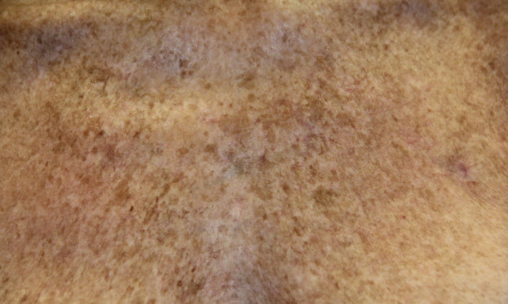 brown-spots-before-IPL