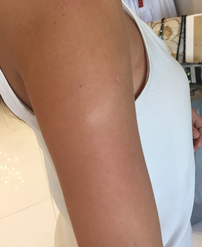 How To Get Rid of Sunspots