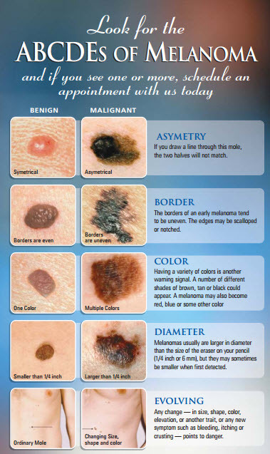 melanoma-facts-abcd