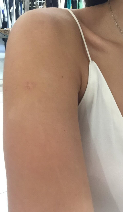 sunspots-on-skin