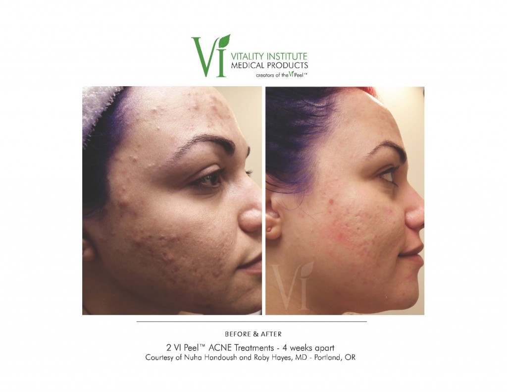 Vi-peel-before-after-picture
