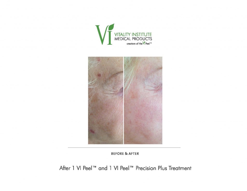 vi-peel-face-before-after