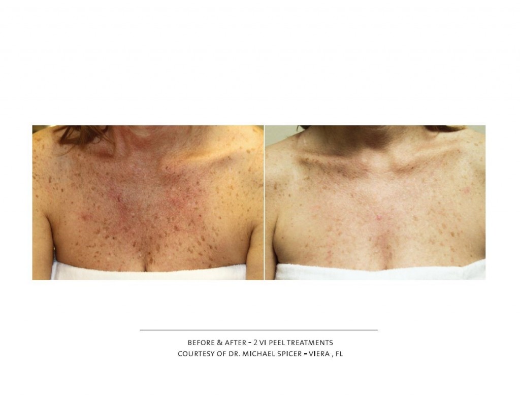 vi-peel-on-chest-before-after