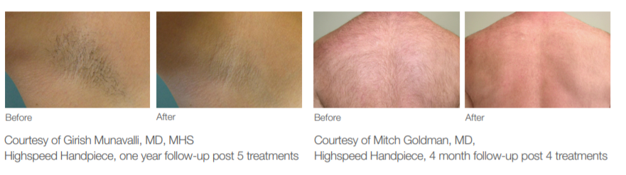 laser hair removal jupiter fl