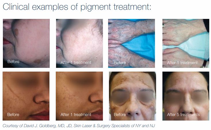 pigmentation removal jupiter fl