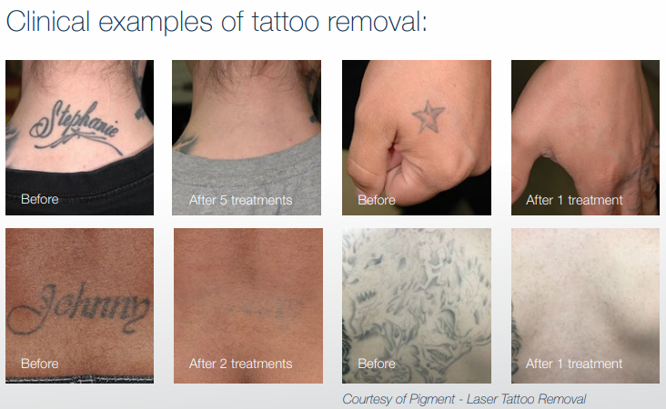 tattoo removal jupiter florida