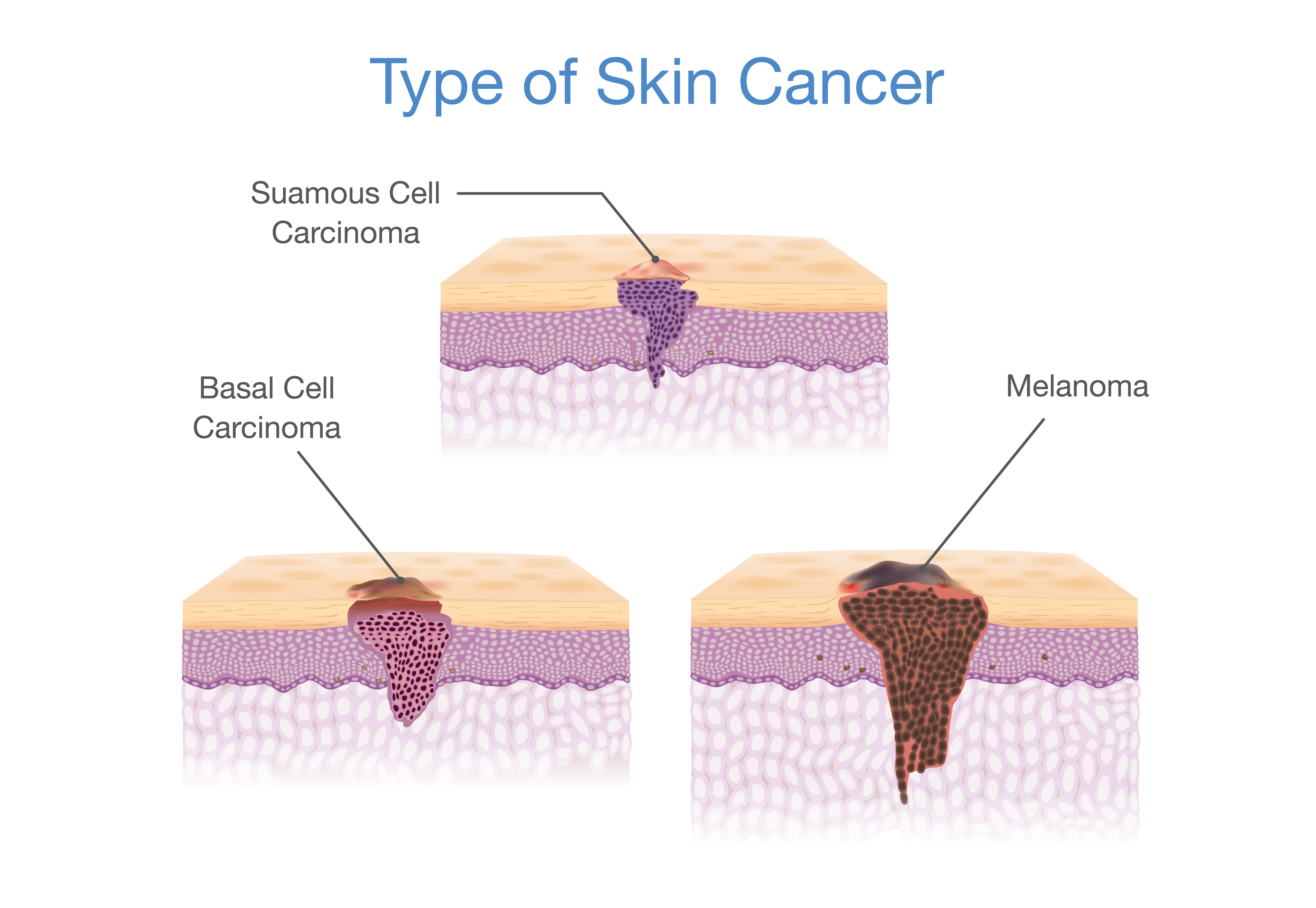 types of skin cancer jupiter fl