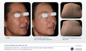resurFX_before_and_after_1