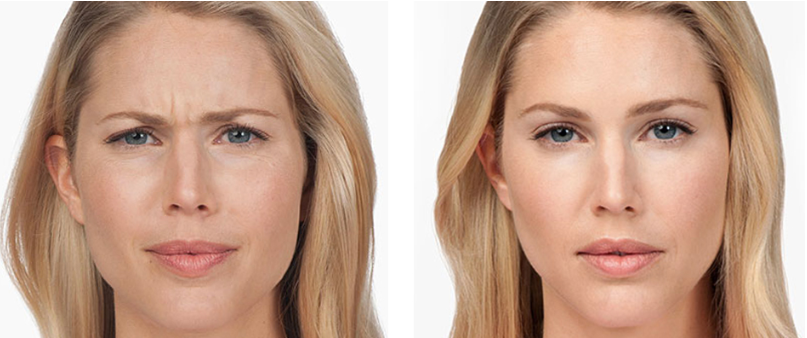 botox results jupiter dermatology
