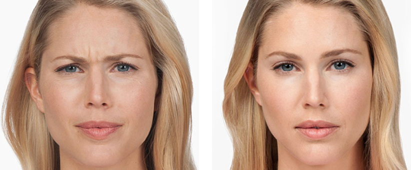jupiter botox results