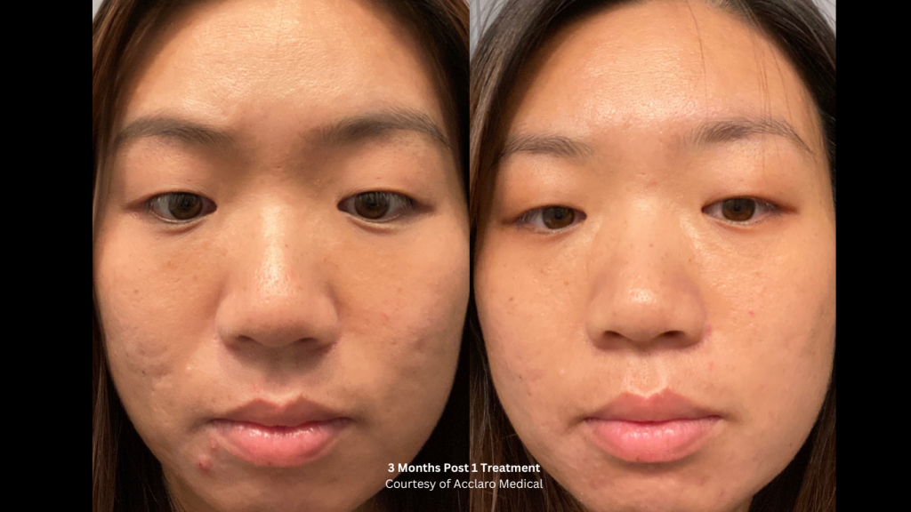 ultra clear before after acne scar 2
