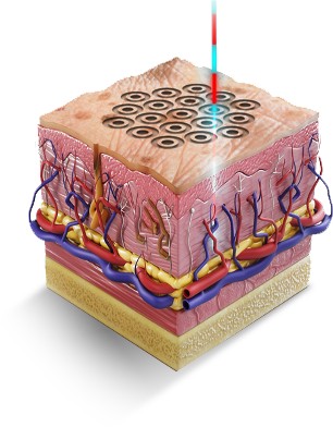 ultra clear high resolution skin resurfacing