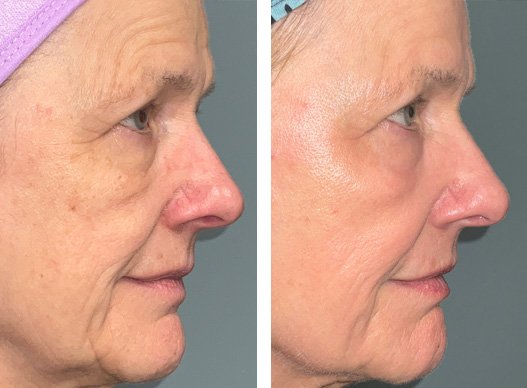 ultraclear laser before and after skin rejuvenation